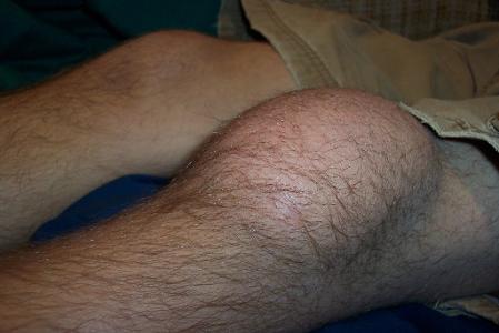 What is the term used for an injury in which the patella (kneecap) slides out of its normal position?