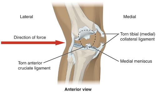 Which basketball injury is characterized by the tearing of a ligament in the knee?