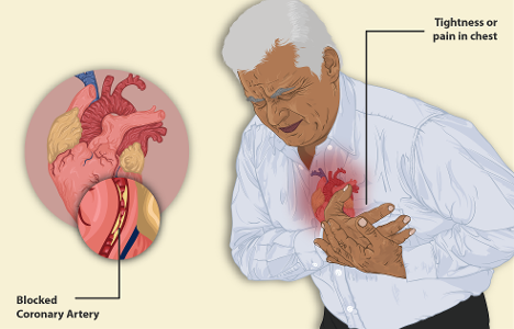 Which of the following is a symptom of a heart attack?