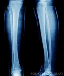 Tib/Fib Tib/Fib