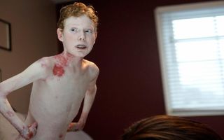 Butterfly Boy's Skin Falls Off With The Slightest Touch Butterfly Boy's Skin Falls Off With The Slightest Touch