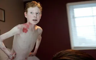 Butterfly Boy's Skin Falls Off With The Slightest Touch Butterfly Boy's Skin Falls Off With The Slightest Touch