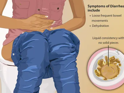 Which of the following is NOT a symptom of mild dehydration?