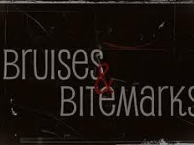Bruises and Bitmarks Bruises and Bitmarks