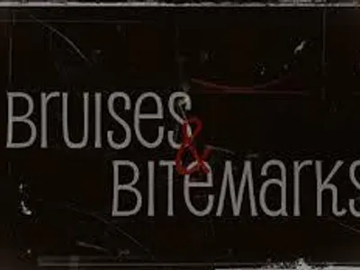Bruises and Bitmarks Bruises and Bitmarks