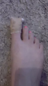 I  injured my toe DX