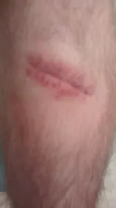 its almost completely healed