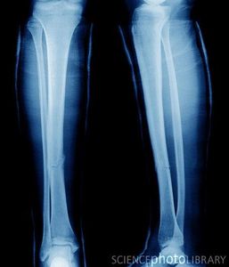 Tib/Fib Tib/Fib