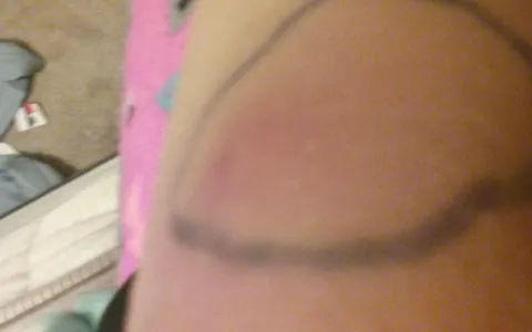 What kind of bug bit me? So, a couple days ago I had a small white bump in the area. I felt nothing nor did I see anything. Then, about a day later, it swelled into a huge, red lump. It's really only itchy, but other than that I feel no pain unless I press something against it. It's been red and swollen for about two days now, and looks like a giant mosquito bite. Any idea if a bug bit me? If so, what kind? What kind of bug bit me? So, a couple days ago I had a small white bump in the area. I felt nothing nor did I see anything. Then, about a day later, it swelled into a huge, red lump. It's really only itchy, but other than that I feel no pain unless I press something against it. It's been red and swollen for about two days now, and looks like a giant mosquito bite. Any idea if a bug bit me? If so, what kind?