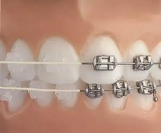 Do you have braces?