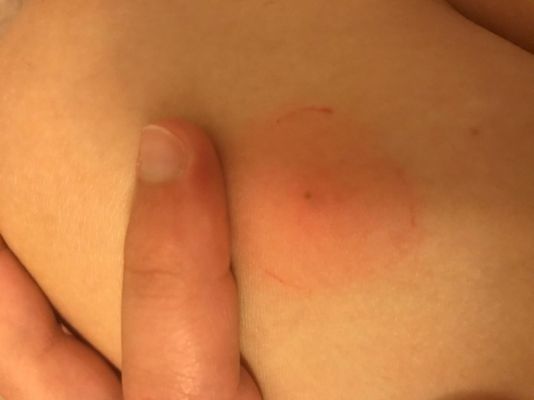 Medical Stuff (Bites and stuff) Okay so i’m gonna type this quick because I already typed this up and QFeast reloaded so I gotta do it again. ;-; About a day, two days ago, I honestly don’t remember, a bump appeared on my leg. It appeared to be a bug bite, but suddenly got more red and swollen. I don’t recall being bit there, but I did have a ton of bug bites all over my body from camping. A week ago, I went camping, and I was bit a lot, mostly from ants and stuff. I only recall being bit once by a tick because I sat on a bench and apparently it crawled on me, but that was it. it wasn’t even on for long, and it was quickly removed. Pretty much, I just want a general idea about if I should be worried or not since I love to make things into a big deal. I bet five hundred bucks it’s nothing, but better save than sorry, amiright? (Also ignore the small red lines. I was copying what my mom did to make sure the circle wasn’t getting bigger.) Medical Stuff (Bites and stuff) Okay so i’m gonna type this quick because I already typed this up and QFeast reloaded so I gotta do it again. ;-; About a day, two days ago, I honestly don’t remember, a bump appeared on my leg. It appeared to be a bug bite, but suddenly got more red and swollen. I don’t recall being bit there, but I did have a ton of bug bites all over my body from camping. A week ago, I went camping, and I was bit a lot, mostly from ants and stuff. I only recall being bit once by a tick because I sat on a bench and apparently it crawled on me, but that was it. it wasn’t even on for long, and it was quickly removed. Pretty much, I just want a general idea about if I should be worried or not since I love to make things into a big deal. I bet five hundred bucks it’s nothing, but better save than sorry, amiright? (Also ignore the small red lines. I was copying what my mom did to make sure the circle wasn’t getting bigger.)