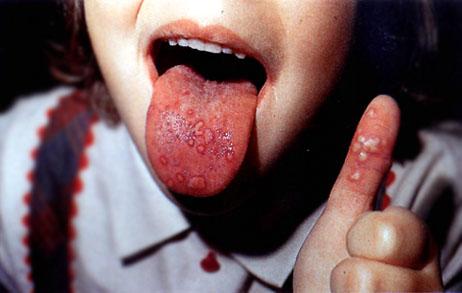 Hand Foot and Mouth Disease