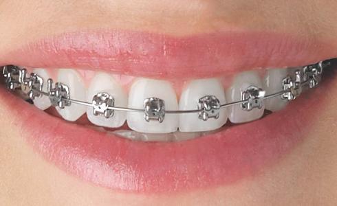 Have I ever had braces?