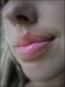 Whose lips were enhanced through lip filler injections?