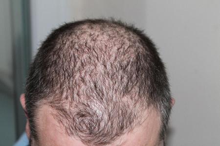 Who is known for his hair transplant procedure?