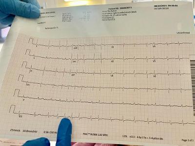 What is the term for a rapid and irregular heartbeat?