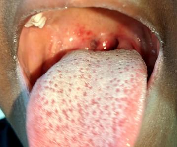 What is a symptom of strep throat?