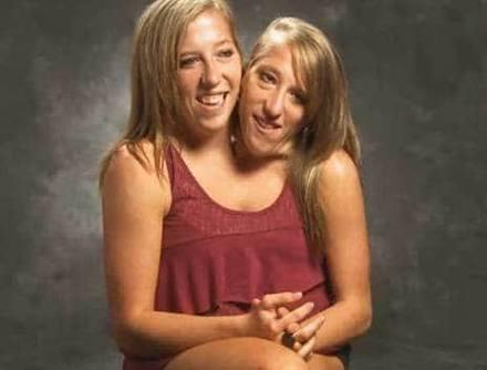 If a conjoined twin has two heads...