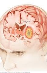 brain.tumor