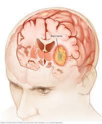 brain.tumor's Photo