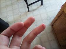 Who knew a butterknife could hurt so much? It took off a small chunk of skin